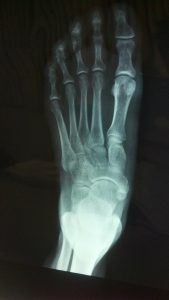 What is a Foot Fracture?